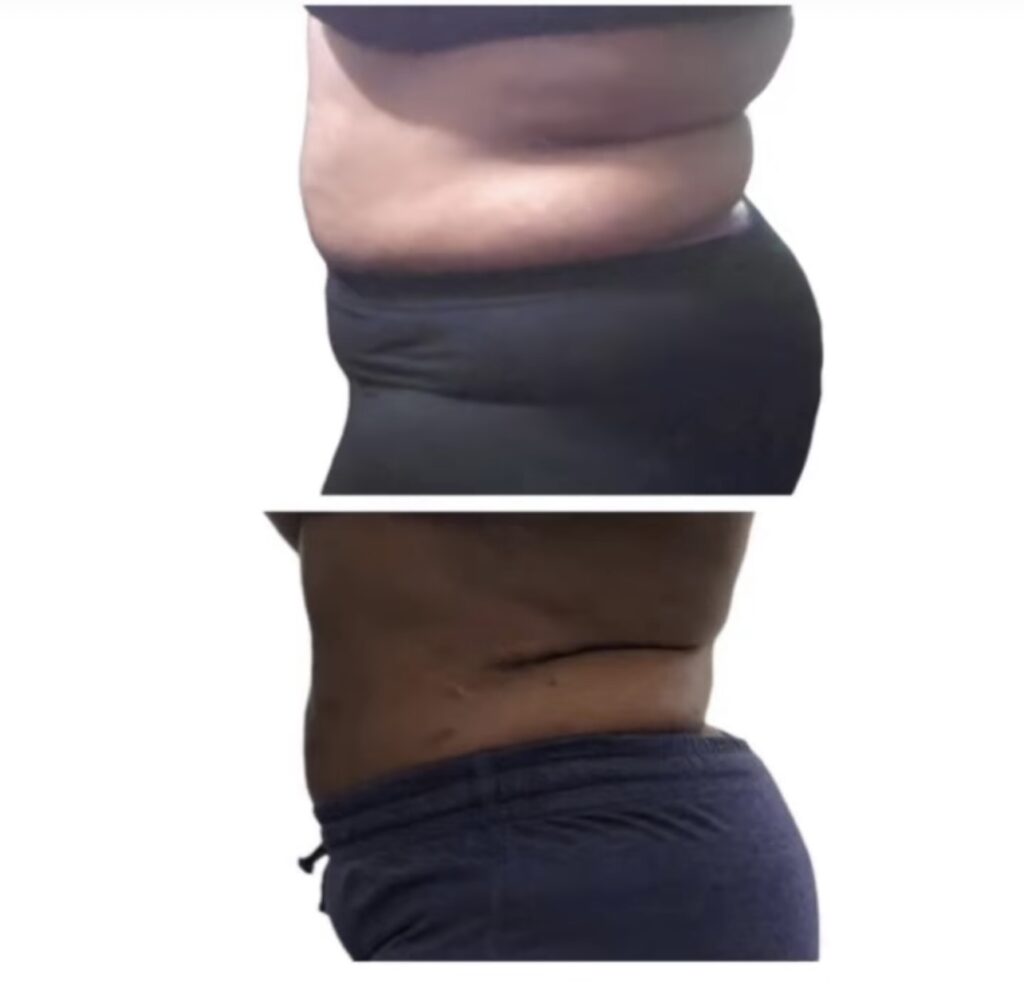 Before and After image of Medical Weight Loss Procedure