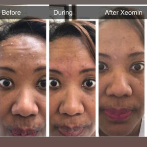 Botox and Xeomin before and after