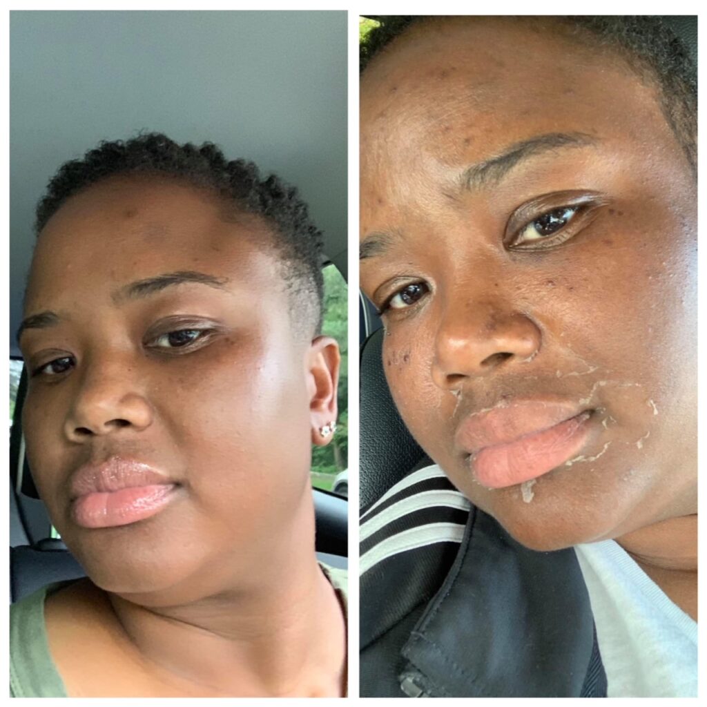 Before and after photos skin peeling
