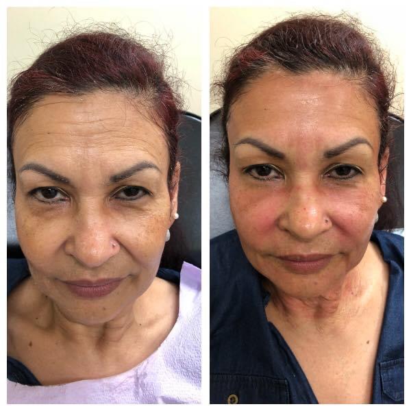 before and after platelet plasma facial