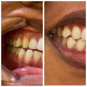 A before and after picture of teeth with yellow stains.