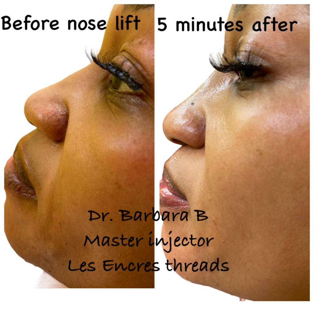 A before and after picture of the nose lift.