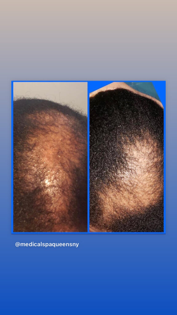 Before and After image of hair growth treatment