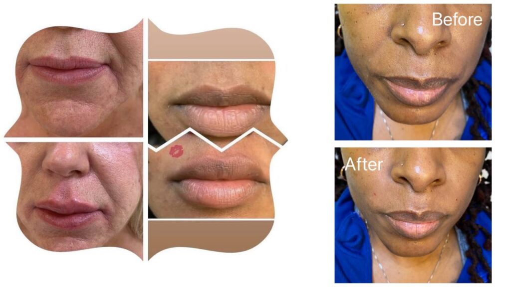 A woman 's lips before and after the procedure.